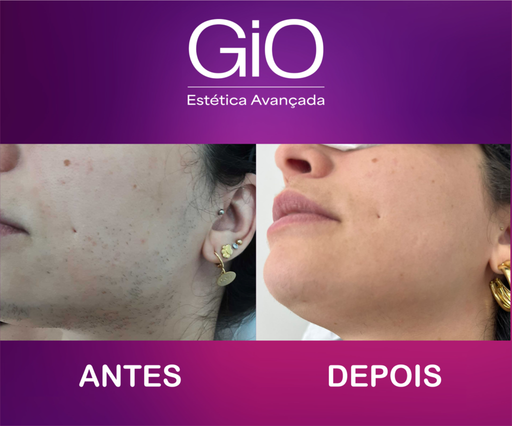 ANTES-DEPOIS-DEPILACAO05