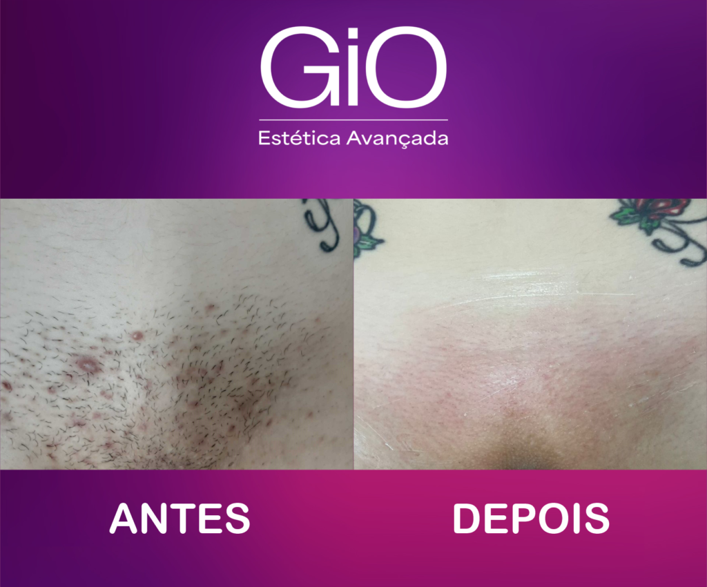 ANTES-DEPOIS-DEPILACAO-01