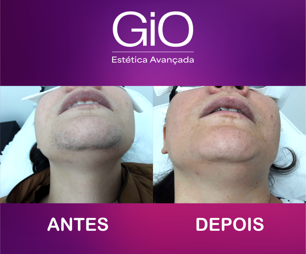 ANTES-DEPOIS-DEPILACAO