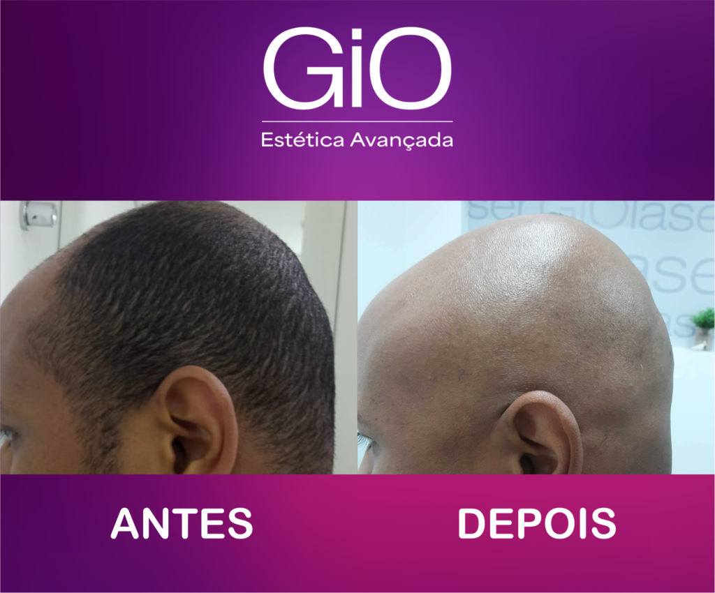 ANTES-DEPOIS-DEPILACAO03