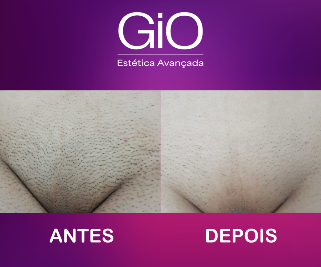 ANTES-DEPOIS-DEPILACAO04